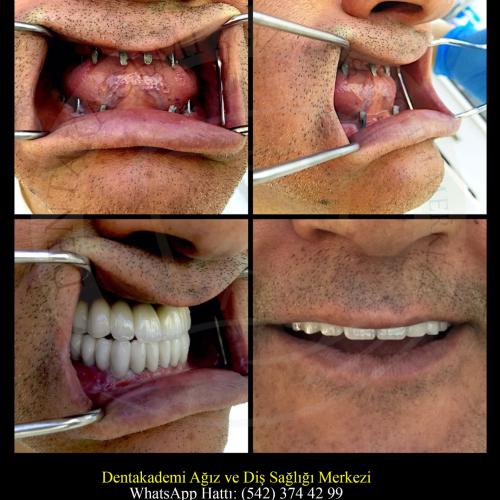 Dental bridge Before / After photo